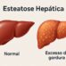 Entenda como a obesidade está relacionada à gordura no fígado